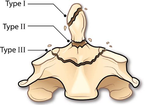 12 Emergency Management of Odontoid Fractures | Neupsy Key