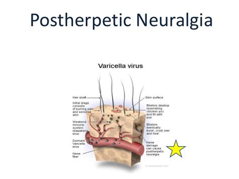 herpetic nerve pain - pictures, photos