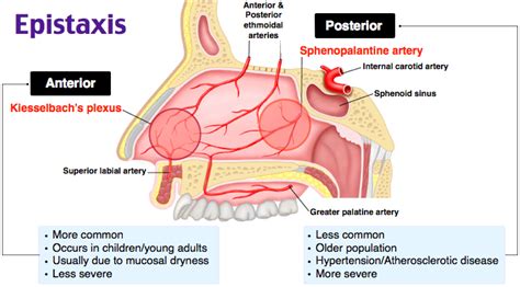 Epistaxis | Emergency medicine, Emergency nursing, Nursing flashcards