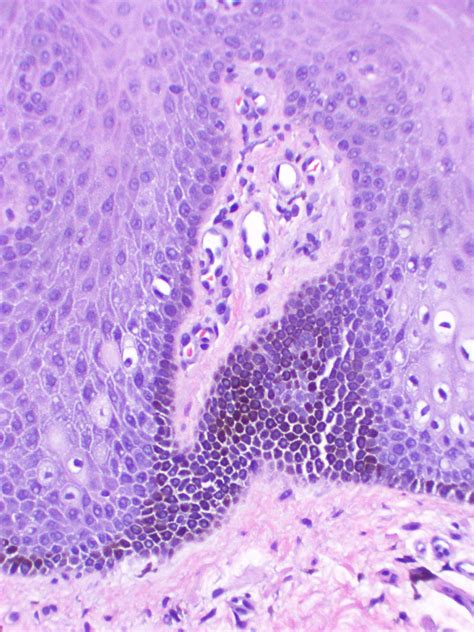 Labial Lentigo (labial melanotic macule) - Dermatology Advisor