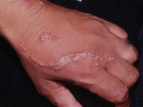 Poison Ivy Rash - Causes, How To Identify Poison Ivy Rash & Treatment