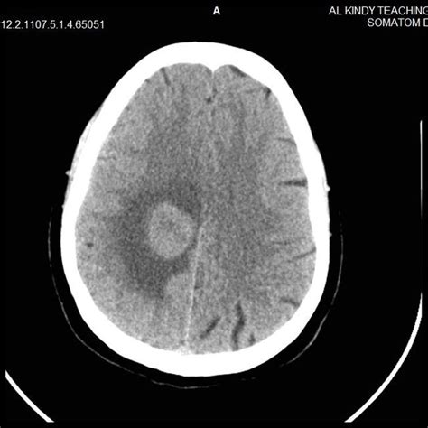 (PDF) Brain Tumor Area Calculation in CT-scan image using Morphological ...