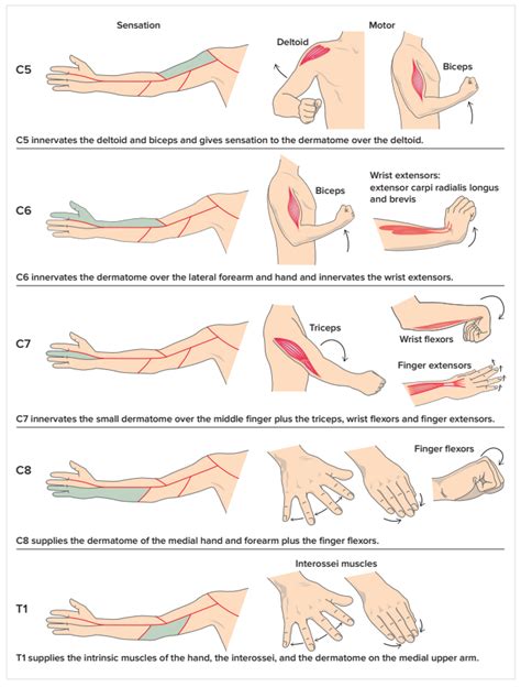 Cervical Radiculopathy - Physiopedia