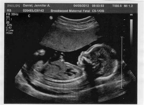 Baby sonogram - silkfas