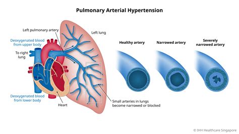 Pulmonary Arterial Hypertension - Symptoms & Causes | Mount Elizabeth ...