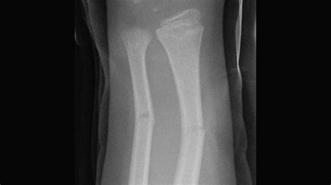 Greenstick Fracture X Ray