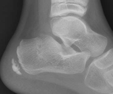 Calcaneus fracture - lokishore