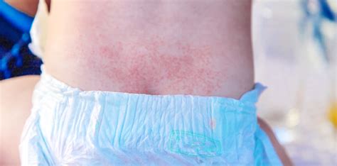 Yeast Diaper Rash (Candida Diaper Dermatitis): Symptoms,