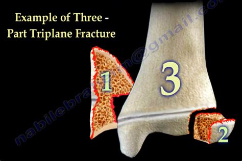 Dr. Nabil Ebraheim's Blogspot: Triplane Fracture of the Distal Tibia