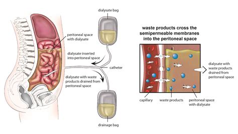 Use the form below to delete this Peritoneal Dialysis image from our ...