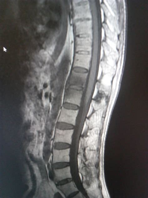 Ankylosing Spondylitis: MRI - Sumer's Radiology Blog