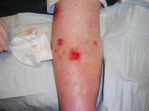 Venous Ulcer Sores - How to Treat