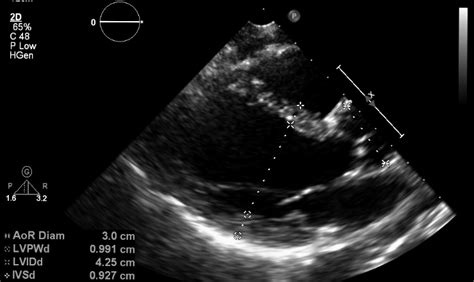 What Does An Echocardiogram Show?