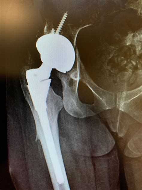 Case Study: Hip dislocation treatment – Acetabular component exchange ...