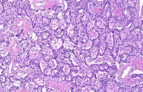 Pathology Outlines - Typical carcinoid tumor / neuroendocrine tumor ...