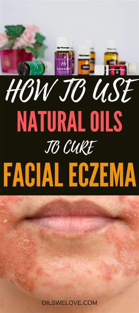 40 Natural Eczema Treatments & Remedies | Natural eczema treatment ...