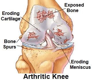 Arthritis in the Knee: Causes, Symptoms & Treatment