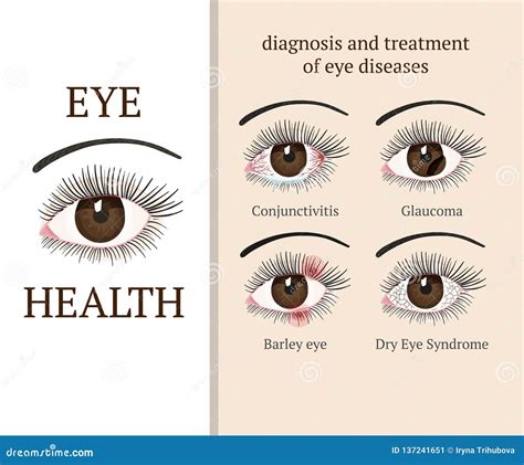 Conjunctivitis Types. Inflammatory Diseases Of Eyes Cartoon Vector ...