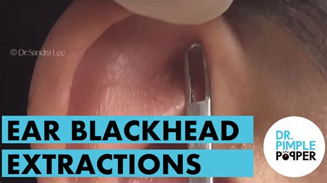 Ear Extractions - Blackheads & Whiteheads Galore - Dr. Pimple Popper