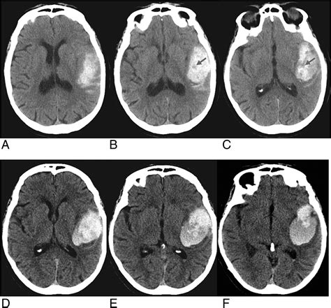 The CT Swirl Sign Is Associated with Hematoma Expansion in ...