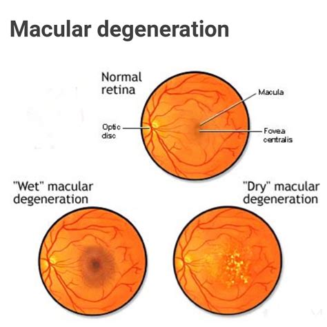 Macular Degeneration Treatment