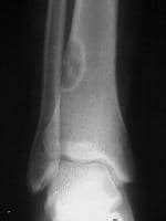 Imaging in Fibrous Cortical Defect and Nonossifying Fibroma