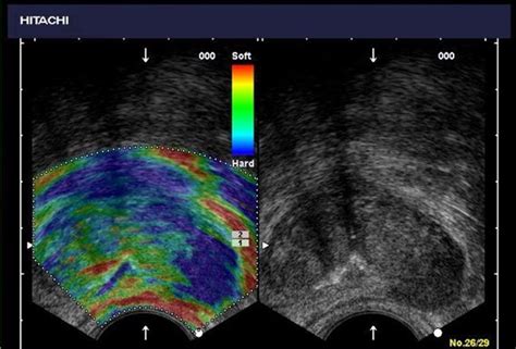 Color-Flow Doppler Ultrasound | Prostate Technology