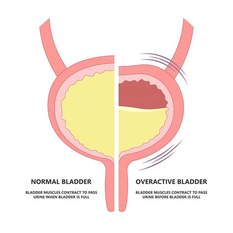 - Pelvic Floor Dysfunction - PFD