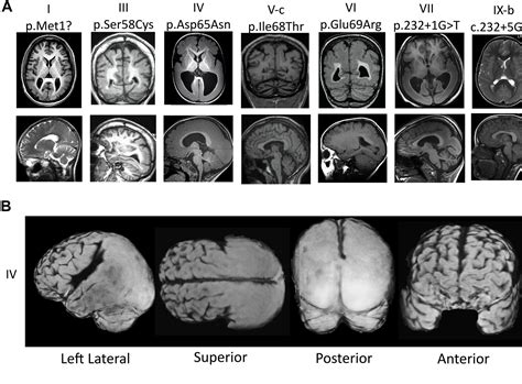 Lissencephaly Mri