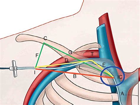 vein is preferred by the the Anatomy Of Subclavian Vein subclavian vein ...