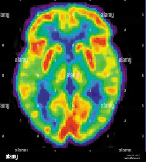 Pet Scan Of Brain Stock Photos & Pet Scan Of Brain Stock Images - Alamy