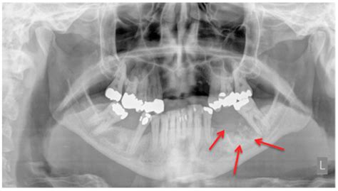 Jaw Cancer Xray - CancerWalls