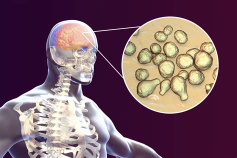 Fungus Shrinks to Get into the Brain