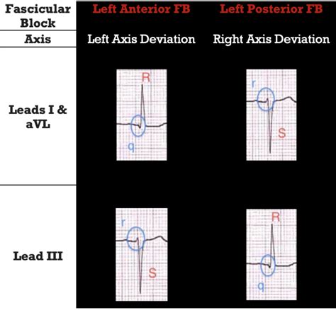 LEFT ANTERIOR FASCICULAR BLOCK – ECG Weekly