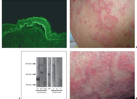 Epidermolysis Bullosa Life Expectancy