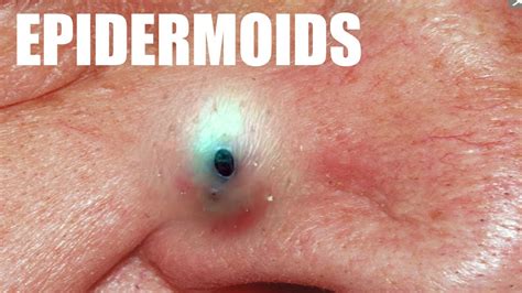 OOZY Epidermoid Cysts - YouTube