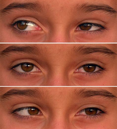 What is Strabismus? | Bay Area Vision