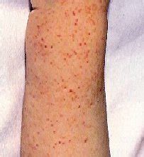 Idiopathic Thrombocytopenic Purpura - Symptoms, Causes, Treatment and ...