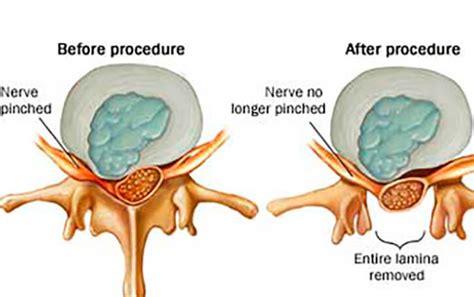 What is a Lumbar Laminectomy? - Premia Spine