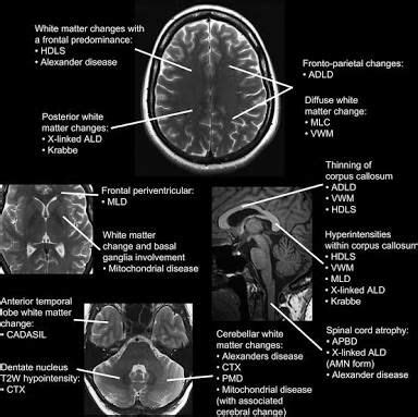 Image result for leukodystrophies radiology approach | Radiology ...