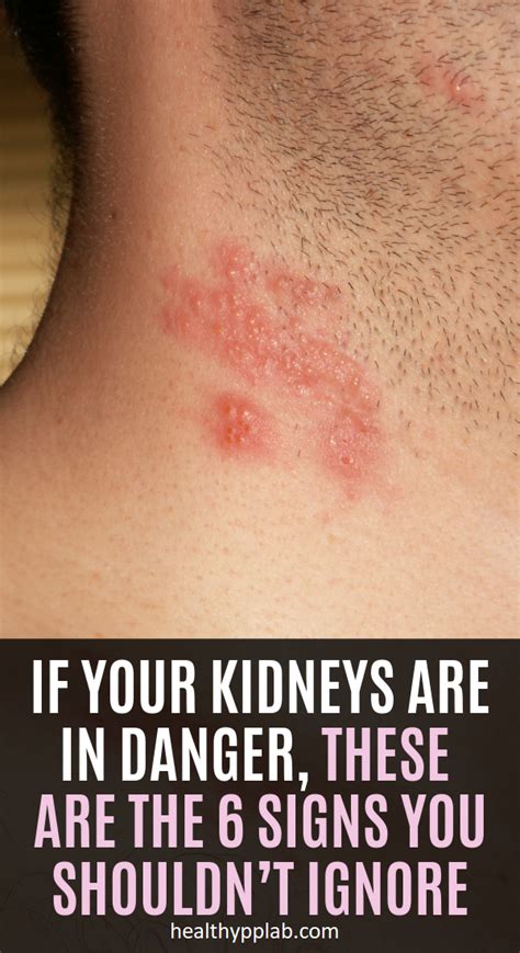 10 Kidney Disease Symptoms You Shouldnt Ignore