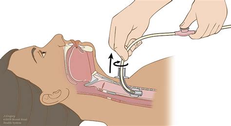 Tracheostomy Tube Suctioning