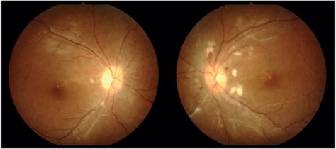 Optic disc photo of both the eyes showing optic disc edema with ...