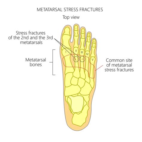 What Is a Stress Fracture? (Types, Signs and Symptoms)