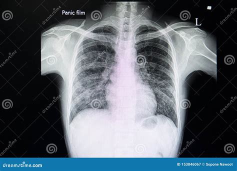 A Chest Xray Film of a Patient with Pneumonia Stock Image - Image of ...