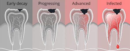 Tooth Decay Treatment in Bushwick, Brooklyn, NY | Dental Caries