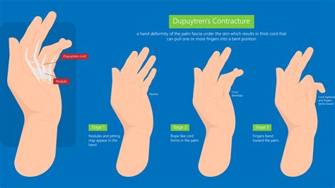 Dupuytren's Contracture Symptoms, Causes & Treatments | Advanced ...