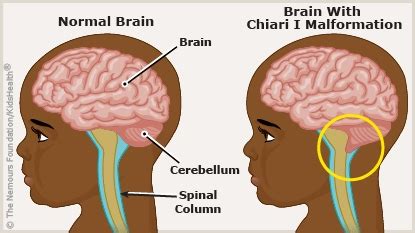 Chiari I Malformation (for Parents) | Nemours KidsHealth