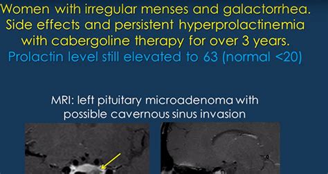 Prolactinoma Symptoms & Treatment | Pacific Pituitary Disorders Center