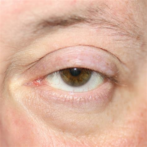 Droopy Eyelids (Ptosis) | Milan Eye Center